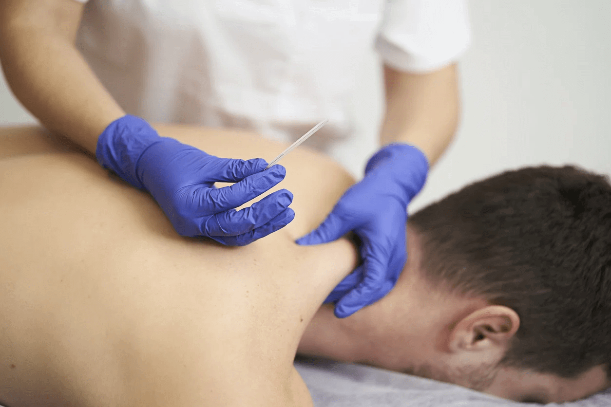 Dry Needling in Physical Therapy