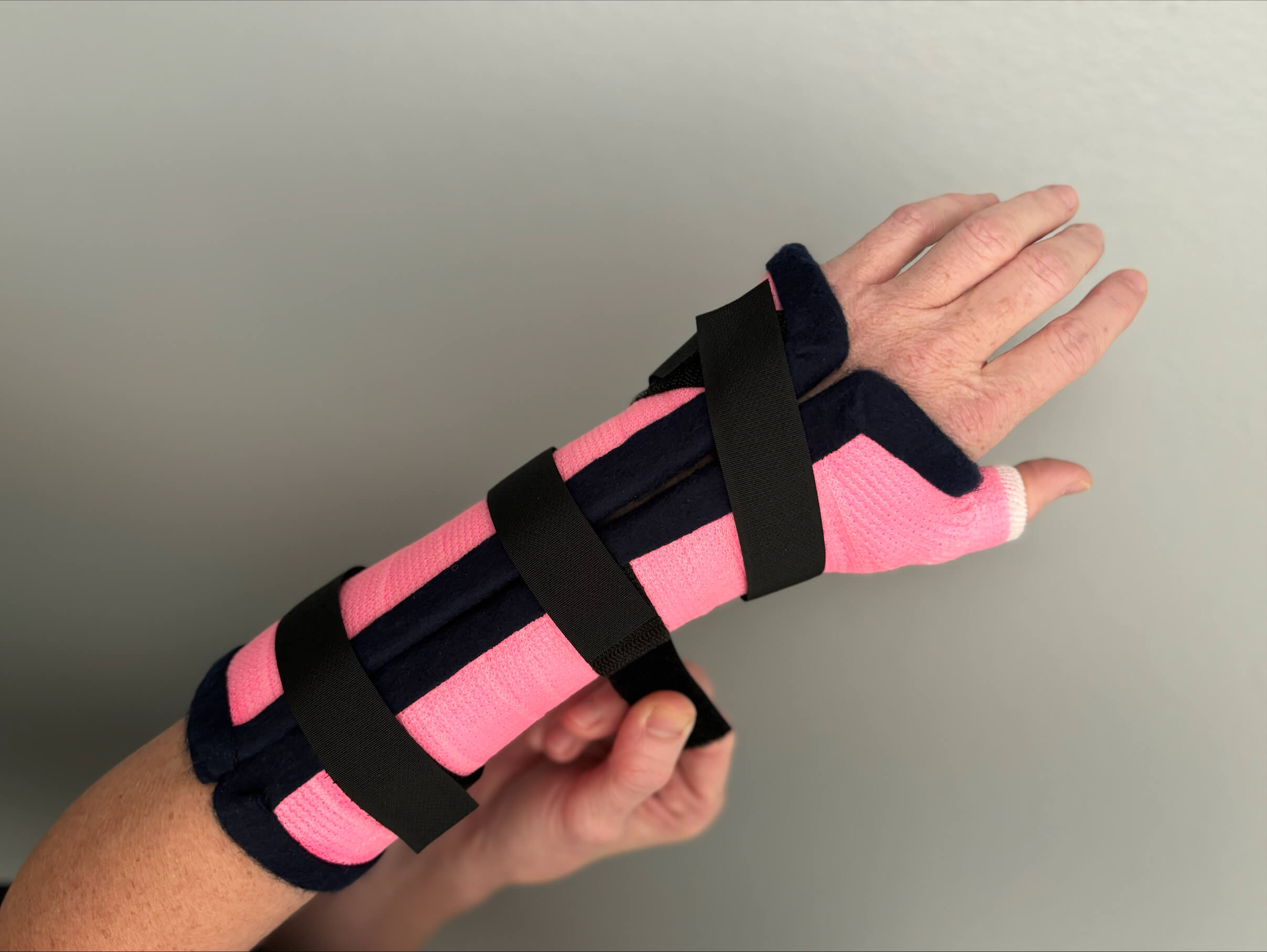 upper extremity orthotic created by occupational therapist